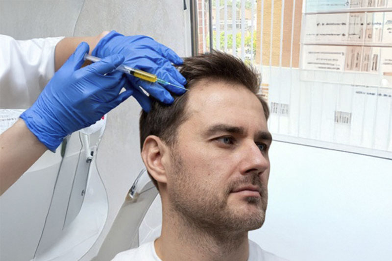 PRP Capilar (Plasma Rico en Plaquetas para Caída del Cabello y Salud Capilar)