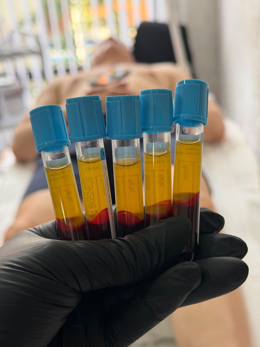 Tubos de plasma rico en plaquetas (PRP) listos para el tratamiento en Zaharum Medellín