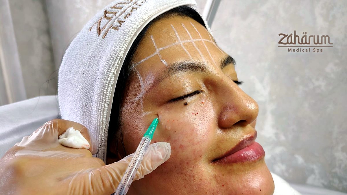 Tratamiento facial con microinyecciones bajo supervisión médica en Medellín Tratamiento facial con microinyecciones bajo supervisión médica en Medellín